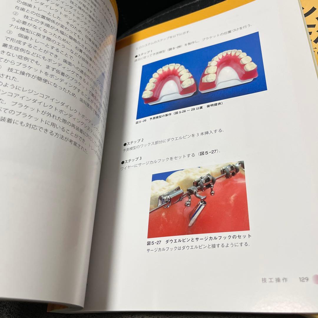 リンガルブラケット矯正法