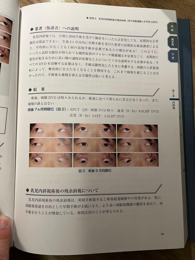 斜視治療のストラテジー